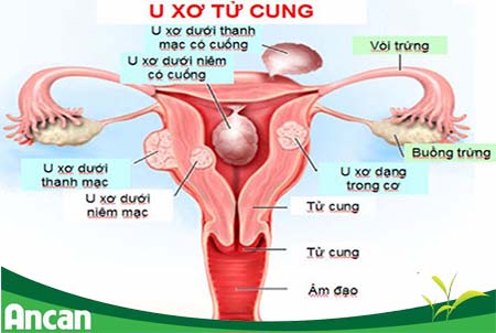 Các biến chứng nguy hiểm của bệnh u xơ tử cung1
