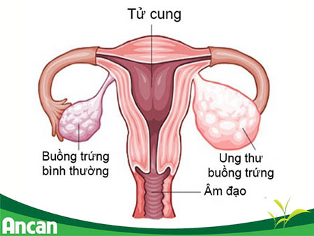 Những dấu hiệu của ung thư buồng trứng chị em cần chú ý 1