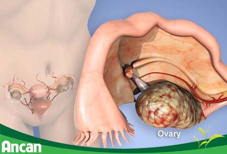 kien-thuc-chung-ve-benh-ung-thu-buong-trung-1