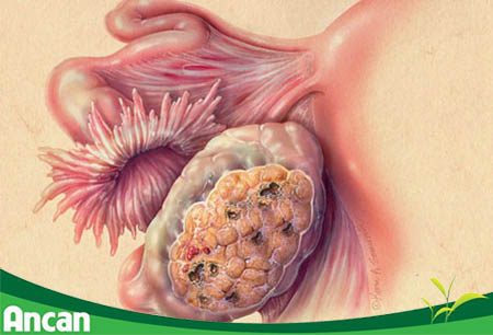 Nguyên nhân của bệnh ung thư buồng trứng 4