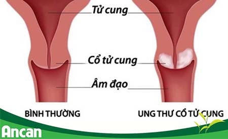 kien-thuc-chung-ve-benh-ung-thu-co-tu-cung-1