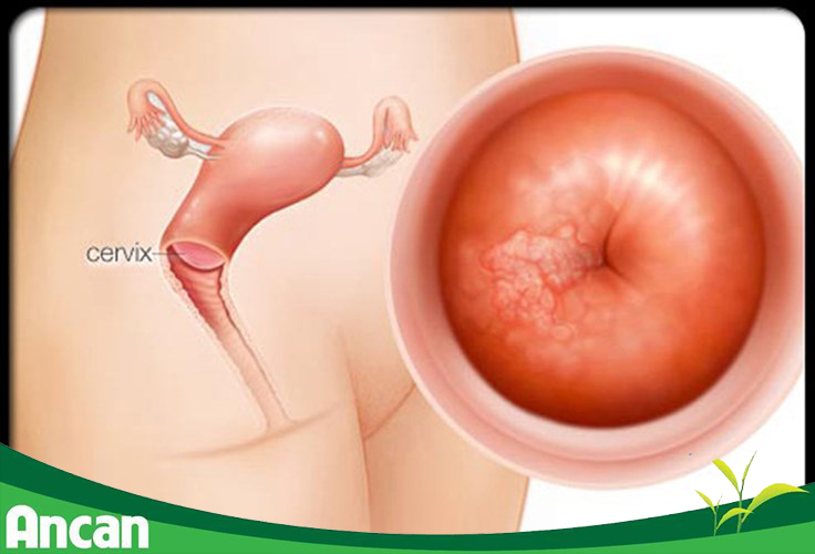 Phòng ngừa ung thư cổ tử cung bằng cách ghi nhớ 8 điều sau