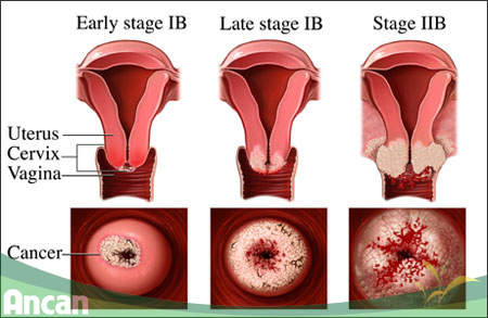 Phòng ngừa ung thư cổ tử cung bằng cách ghi nhớ 8 điều sau 2