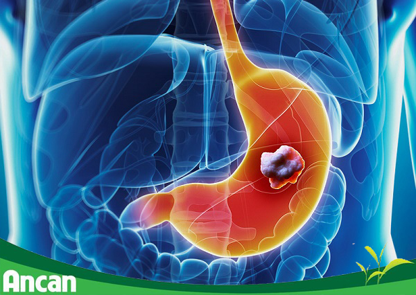 Các phương pháp điều trị ung thư dạ dày