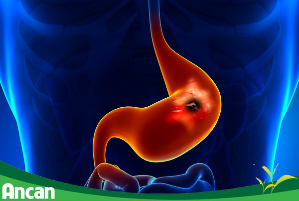 Nguyên nhân của bệnh ung thư dạ dày