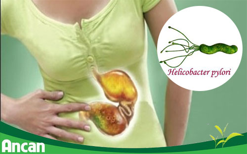 Thủ phạm gây ung thư dạ dày ở 70% người Việt 1