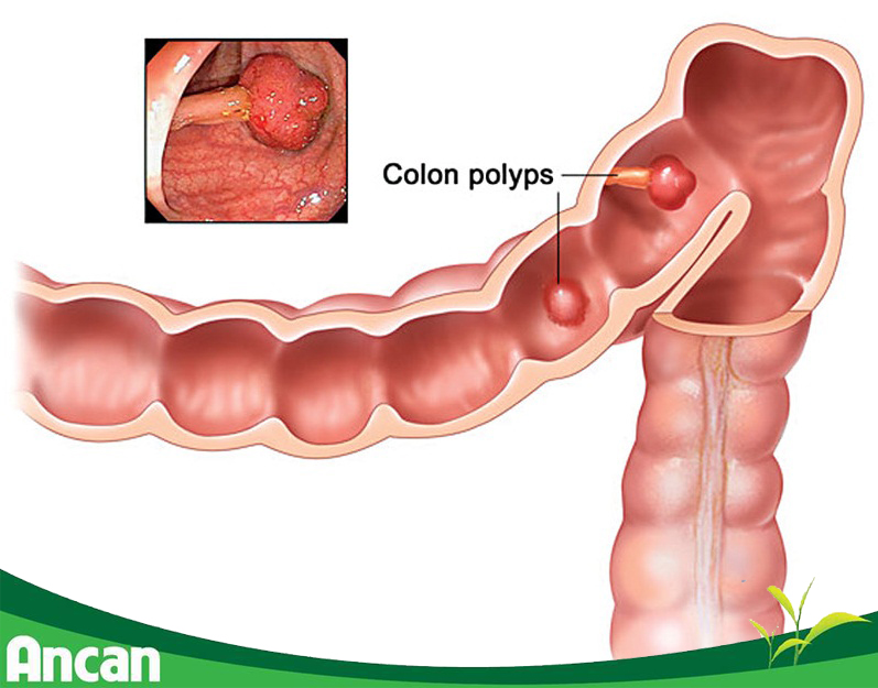 Ai có nguy cơ cao mắc bệnh ung thư đại tràng 2