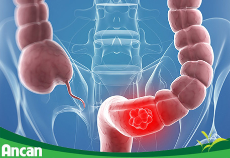 Các biện pháp phòng tránh ung thư đại tràng 1