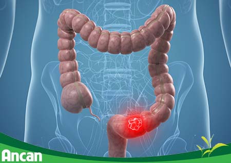 Các phương pháp điều trị ung thư đại tràng giai đoạn 2 (1)