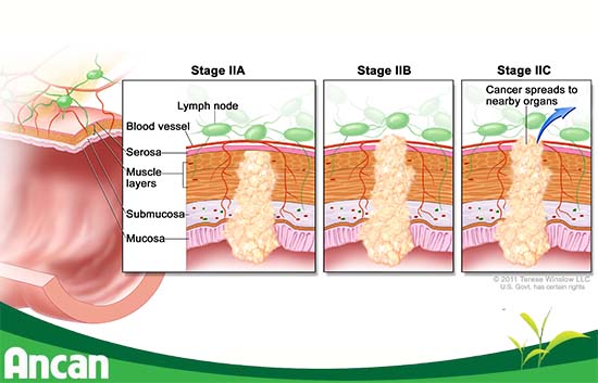 Các phương pháp điều trị ung thư đại tràng giai đoạn 2 (2)