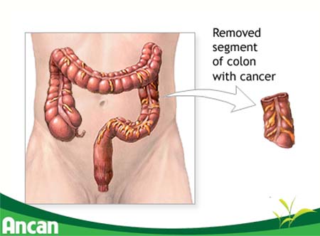 Các phương pháp điều trị ung thư đại tràng giai đoạn 2 (3)