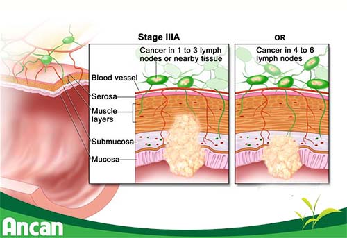 Cách điều trị ung thư đại tràng giai đoạn 3 (2)