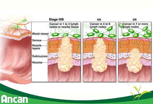 Cách điều trị ung thư đại tràng giai đoạn 3 (2)