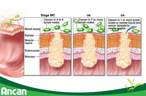 Cách điều trị ung thư đại tràng giai đoạn 3 (3)