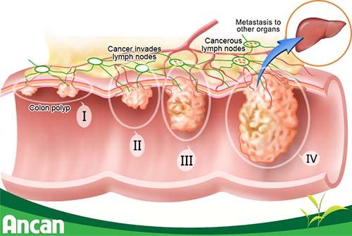 Cách điều trị ung thư đại tràng giai đoạn 3 (1)