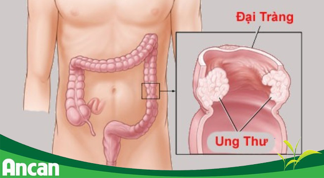 Dấu hiệu ung thư đại tràng 4