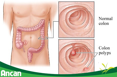 Dấu hiệu ung thư đại tràng 1