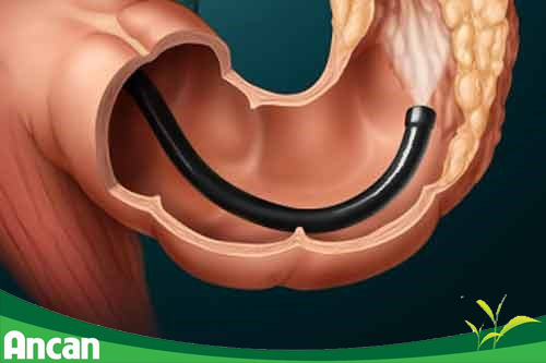 Dấu hiệu ung thư đại tràng 5