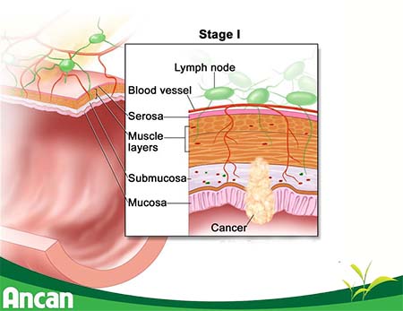 Dấu hiệu ung thư đại tràng giai đoạn đầu và cách chữa trị 4