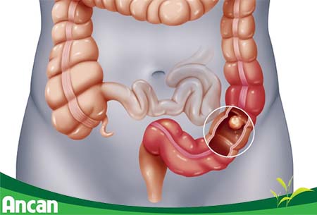 kien-thuc-chung-ve-benh-ung-thu-dai-trang-2