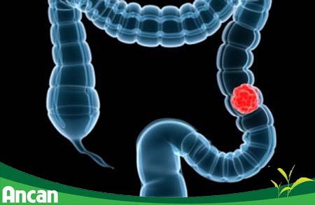Nguyên nhân của bệnh ung thư đại tràng 1