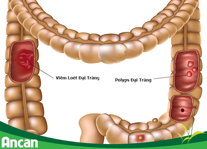 Nguyên nhân của bệnh ung thư đại tràng 3