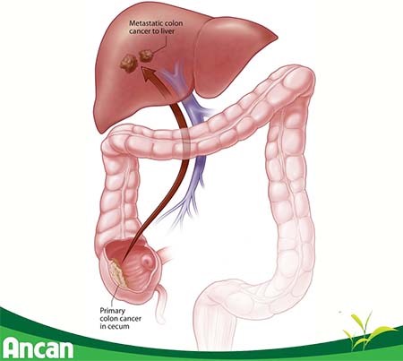 Triệu chứng ung thư đại tràng di căn 2
