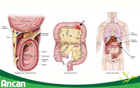 Ung Thư Trực Tràng Di Căn Hạch: Hiểu Biết và Hướng Dẫn Chăm Sóc