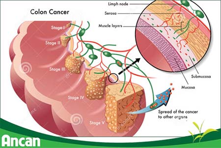 Triệu chứng ung thư đại tràng di căn 1