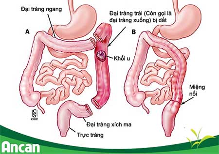 Ung thư đại tràng có lây không? Tìm hiểu sự thật và cách phòng ngừa hiệu quả