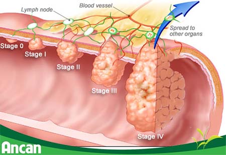 Ung thư đại tràng giai đoạn cuối sống được bao lâu 1