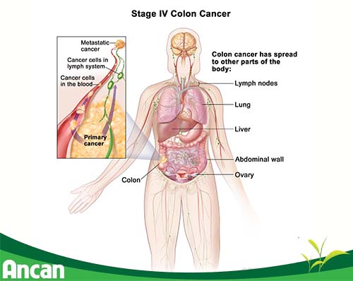 Ung thư đại tràng giai đoạn cuối sống được bao lâu 3