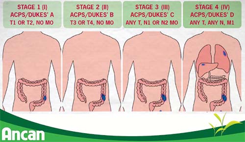 Ung thư đại tràng giai đoạn cuối sống được bao lâu 2