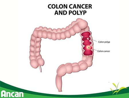 Ung thư đại tràng sống được bao lâu 2