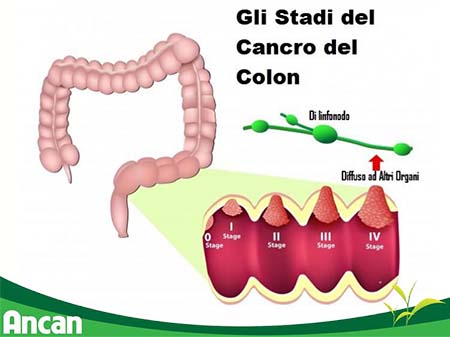 Ung thư đại tràng sống được bao lâu 1