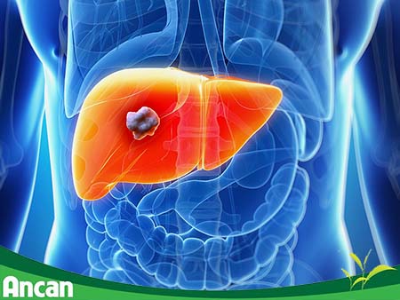 Các phương pháp điều trị ung thư gan giai đoạn 2 1