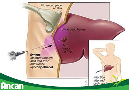Các phương pháp điều trị ung thư gan giai đoạn 2 2