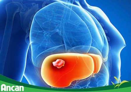 Các phương pháp điều trị ung thư gan giai đoạn 3 1