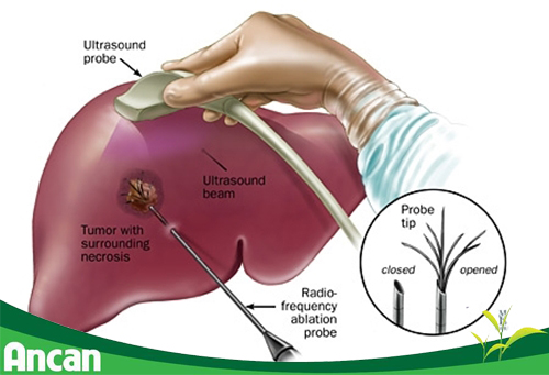 Các phương pháp điều trị ung thư gan hiện nay 3