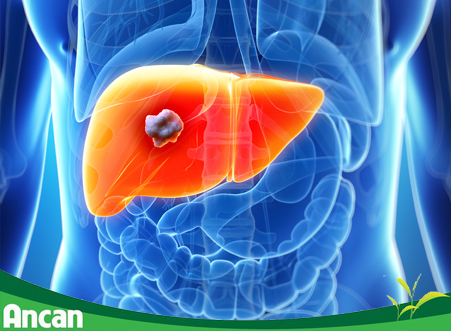 Dấu hiệu của bệnh ung thư gan qua từng giai đoạn 1