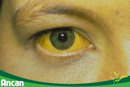 Điều trị ung thư gan giai đoạn cuối 2