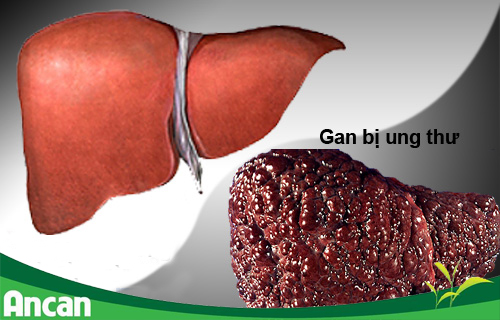 Mắc ung thư gan do ăn thực phẩm mốc 3