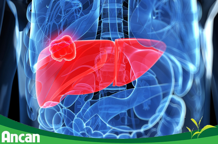 Nguyên nhân gây ung thư gan 1