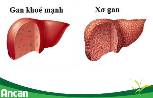 Nguyên nhân gây ung thư gan 2