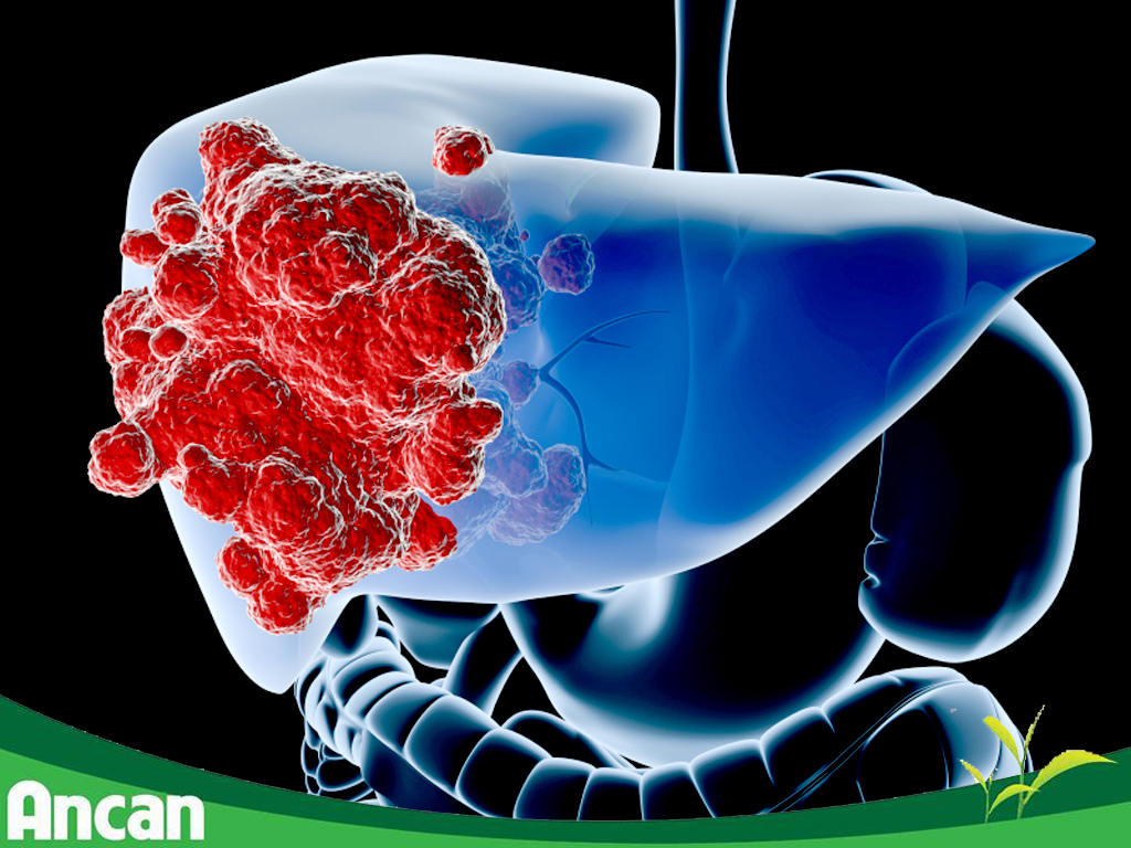Nguyên nhân gây ung thư gan 4