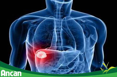 Ung thư gan là gì 1