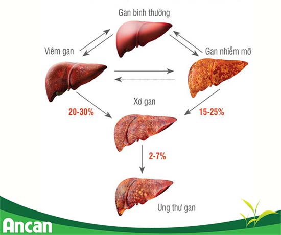 Phương pháp chẩn đoán bệnh K gan