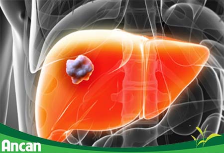 ung-thu-gan-nguyen-nhan-trieu-chung-va-cach-dieu-tri-1