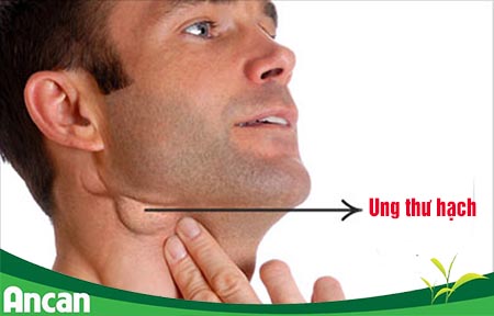 ung-thu-hach-nguyen-nhan-trieu-chung-va-cach-dieu-tri-1