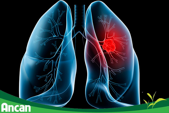 8 biện pháp phòng tránh bệnh ung thư phổi 1